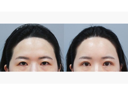 상안검+눈매교정+윗트임