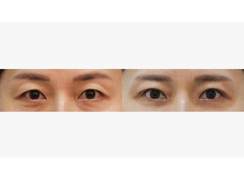 상안검+눈밑지방재배치+눈밑지방이식