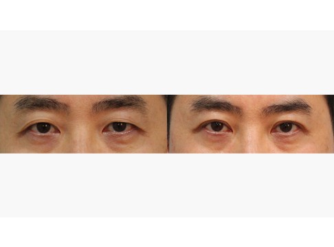 상안검