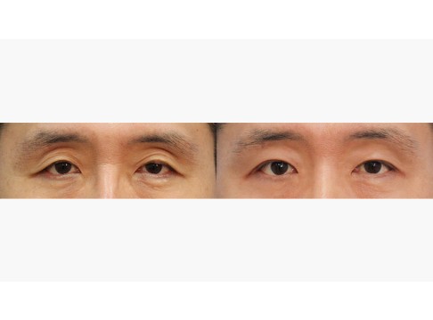 상안검