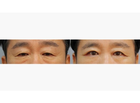 상안검