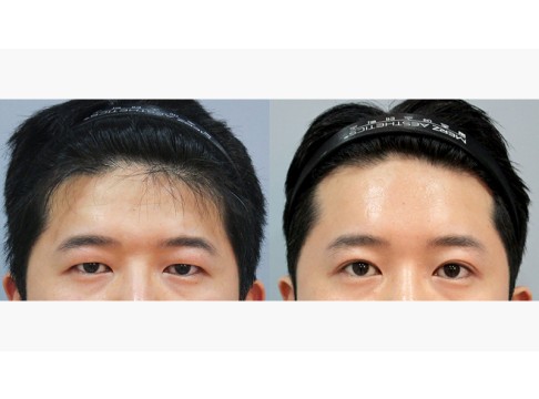 상안검