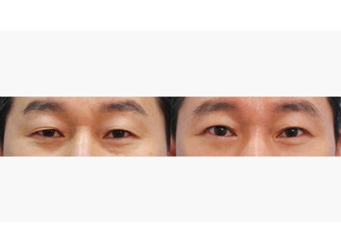 상안검