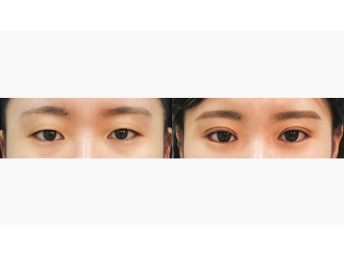자연유착+뒷트임+밑트임